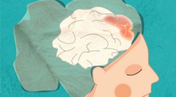 Ilustración sobre como chega o ictus ao cerebro
